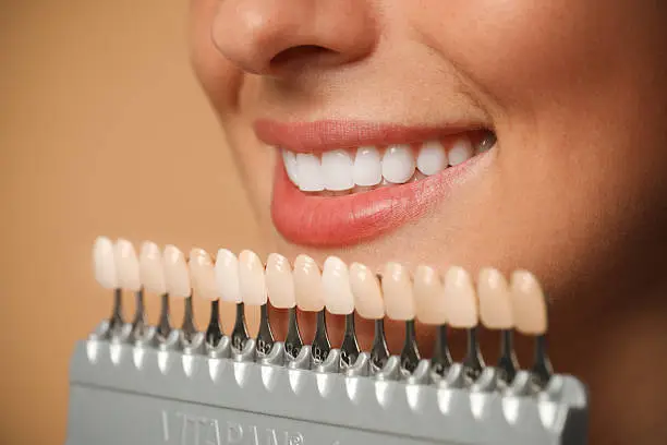 Sorriso perfetto con trattamenti di estetica dentale — Studio Dentistico Barbara Vertechy